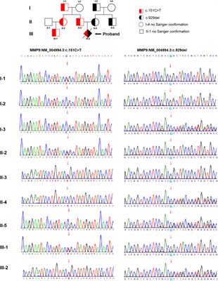 Identification of Novel Compound Heterozygous Variants of MMP9 in Fetus With Metaphyseal Anadysplasia Type 2